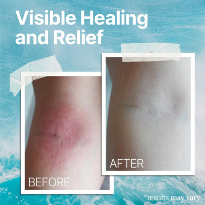 The Ocean Healed My Eczema™ – Eczema & Psoriasis Relief for Sensitive Skin