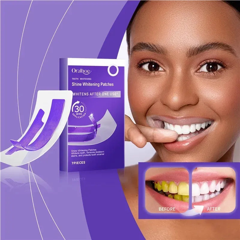 Teeth Whitening Strips — Whiter Teeth in Just 30 Minutes