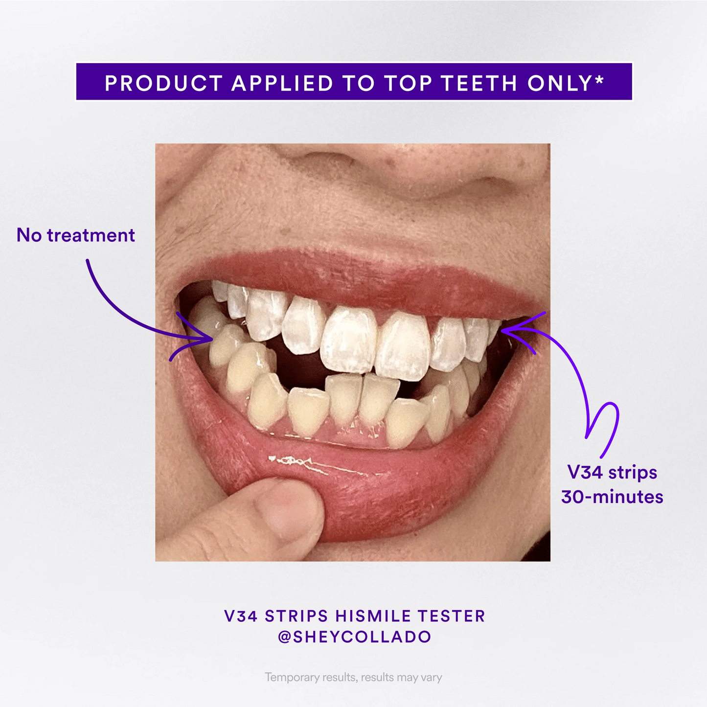 Teeth Whitening Strips — Whiter Teeth in Just 30 Minutes