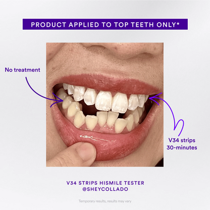 Teeth Whitening Strips — Whiter Teeth in Just 30 Minutes