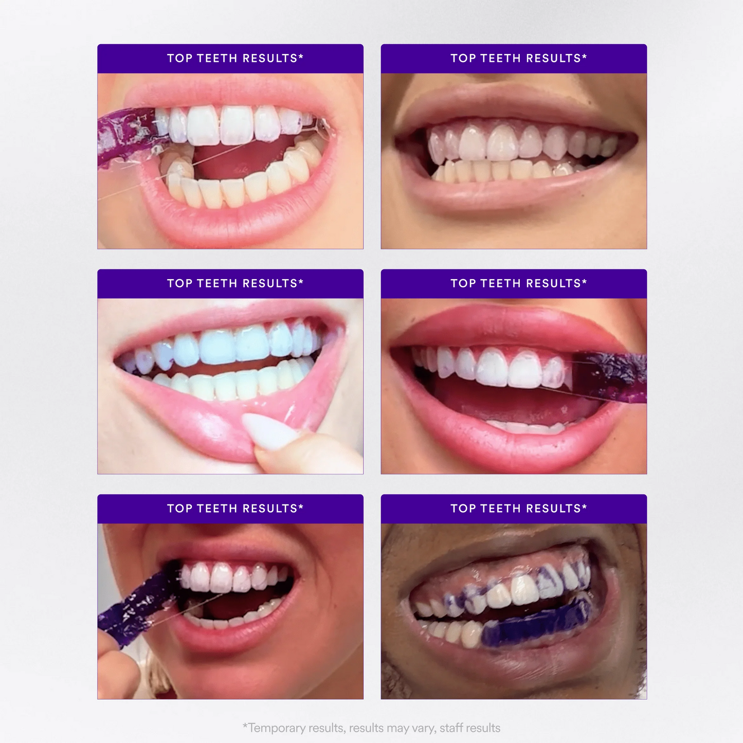 Teeth Whitening Strips — Whiter Teeth in Just 30 Minutes